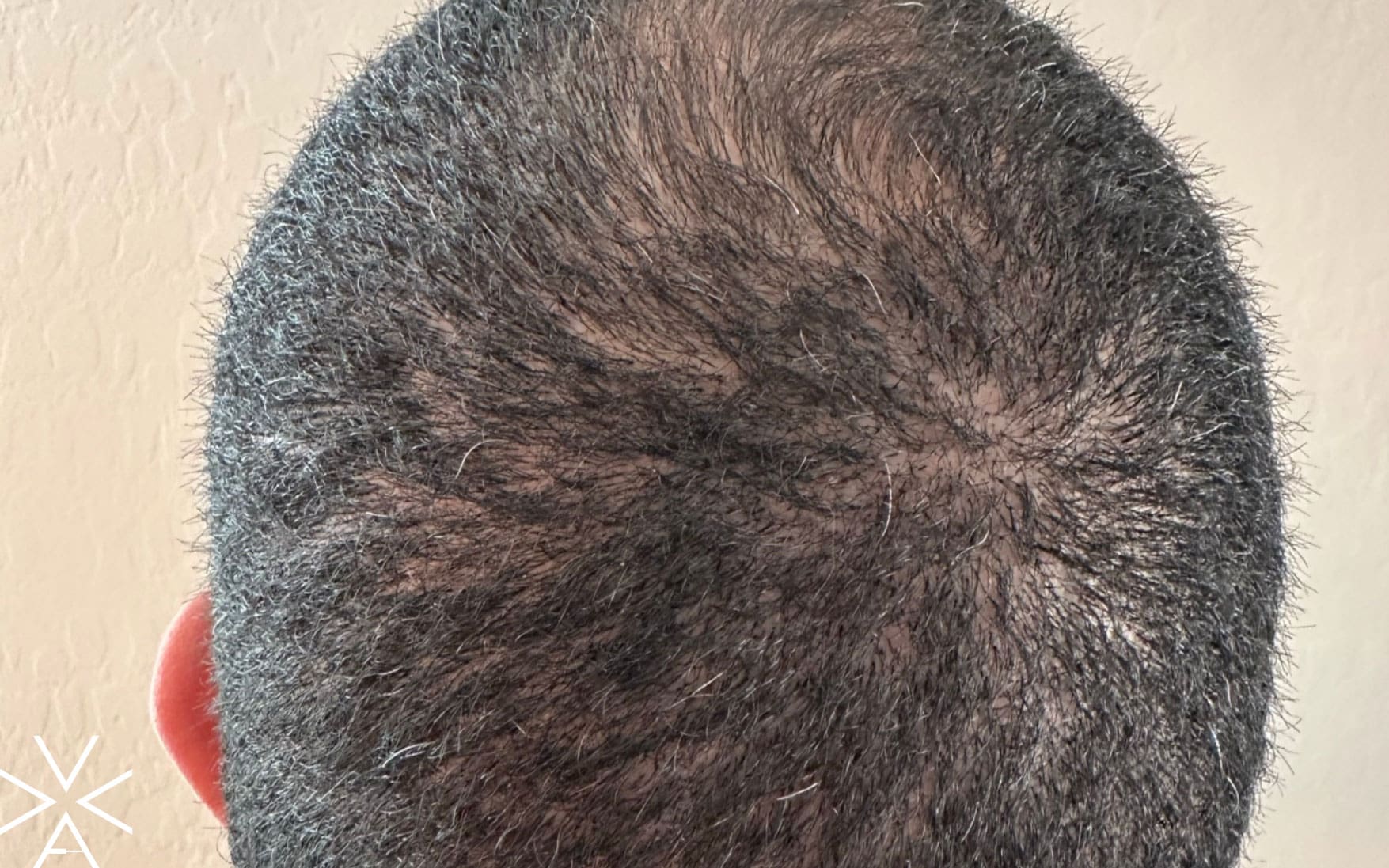 hair restoration after