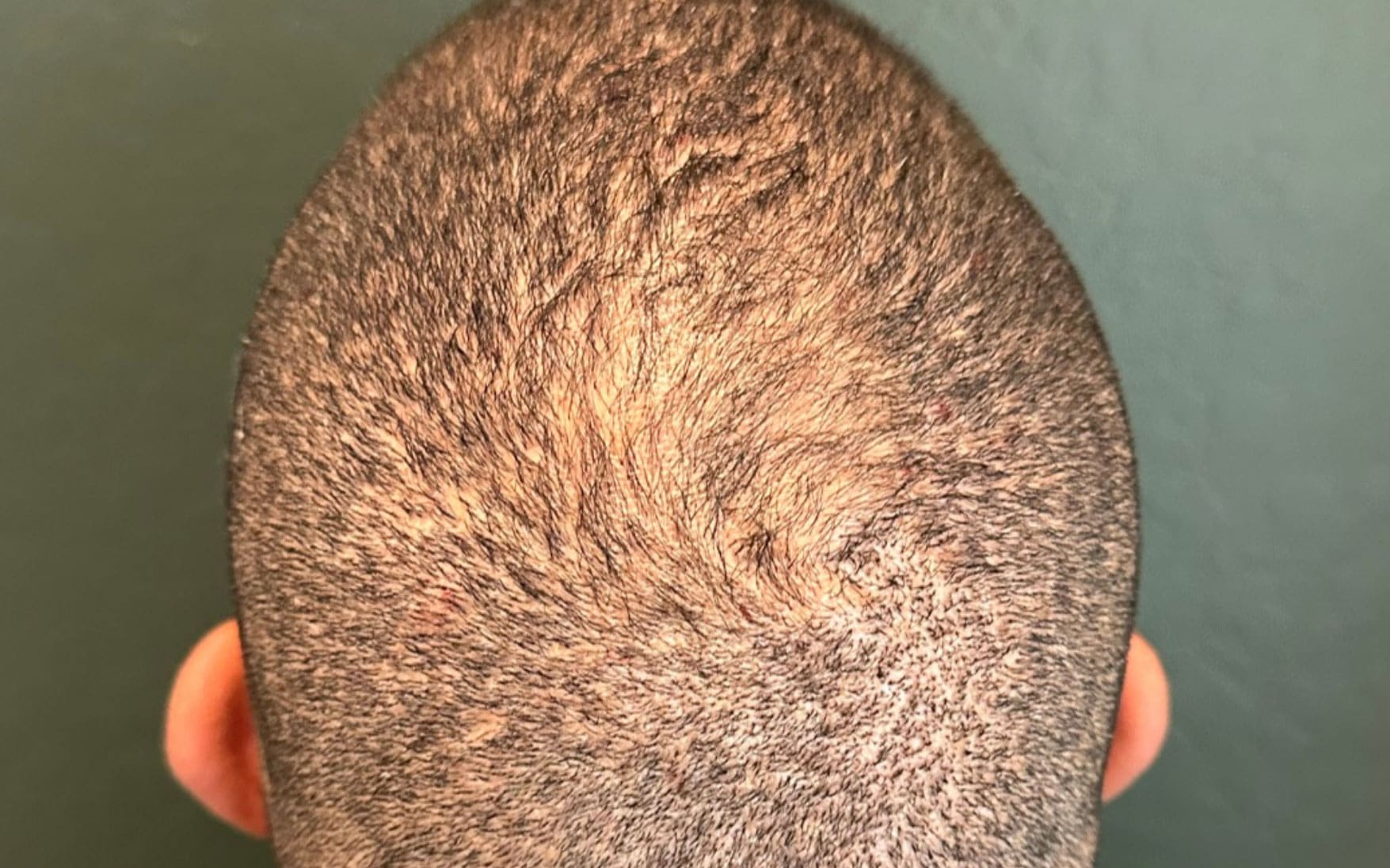 hair restoration before