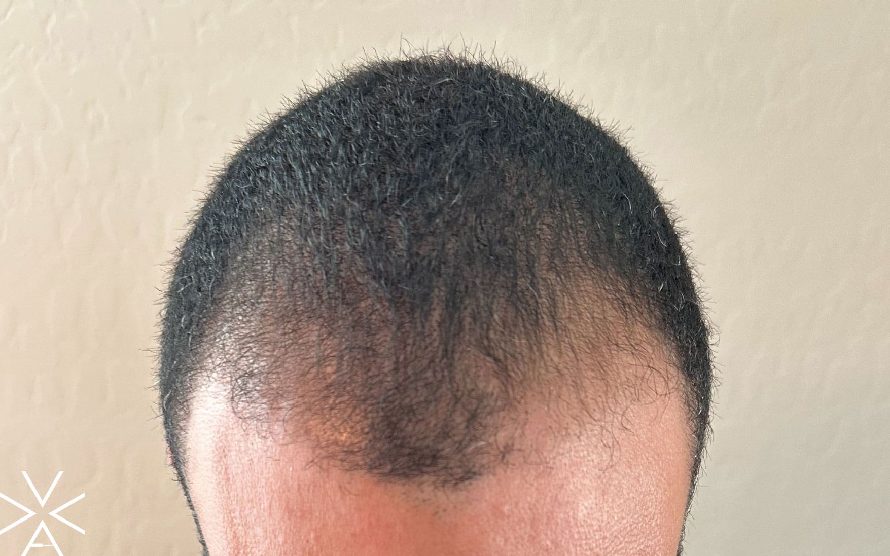 hair restoration after - Before & After Gallery