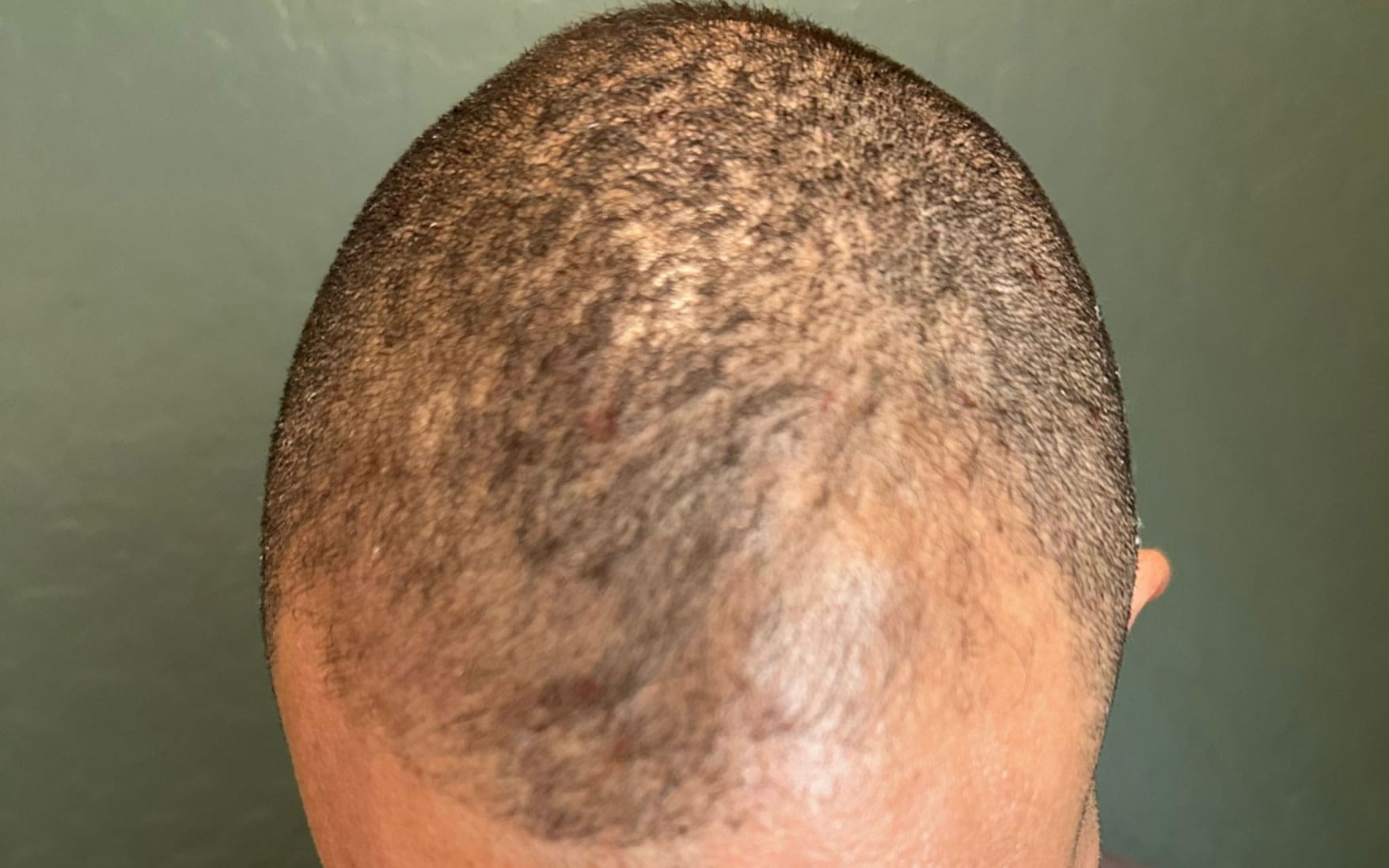 hair restoration before