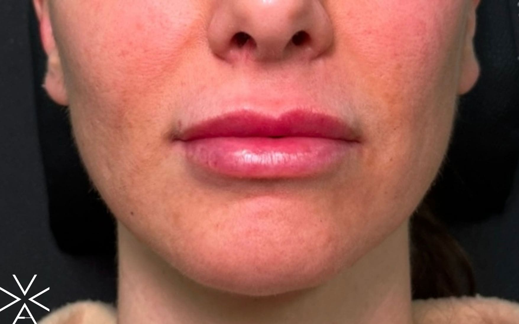 Lip filler after - Before & After Gallery