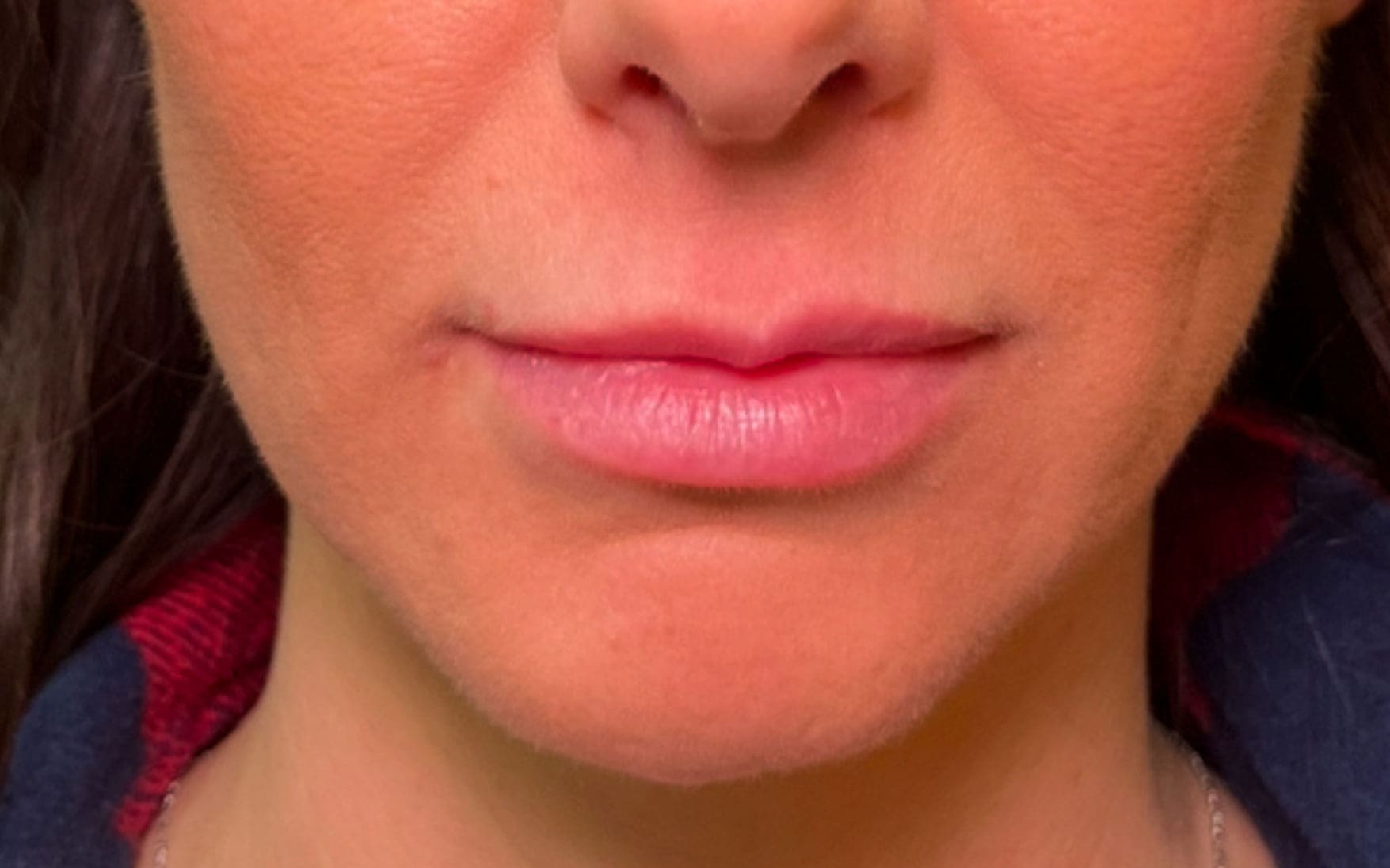 Lip filler before