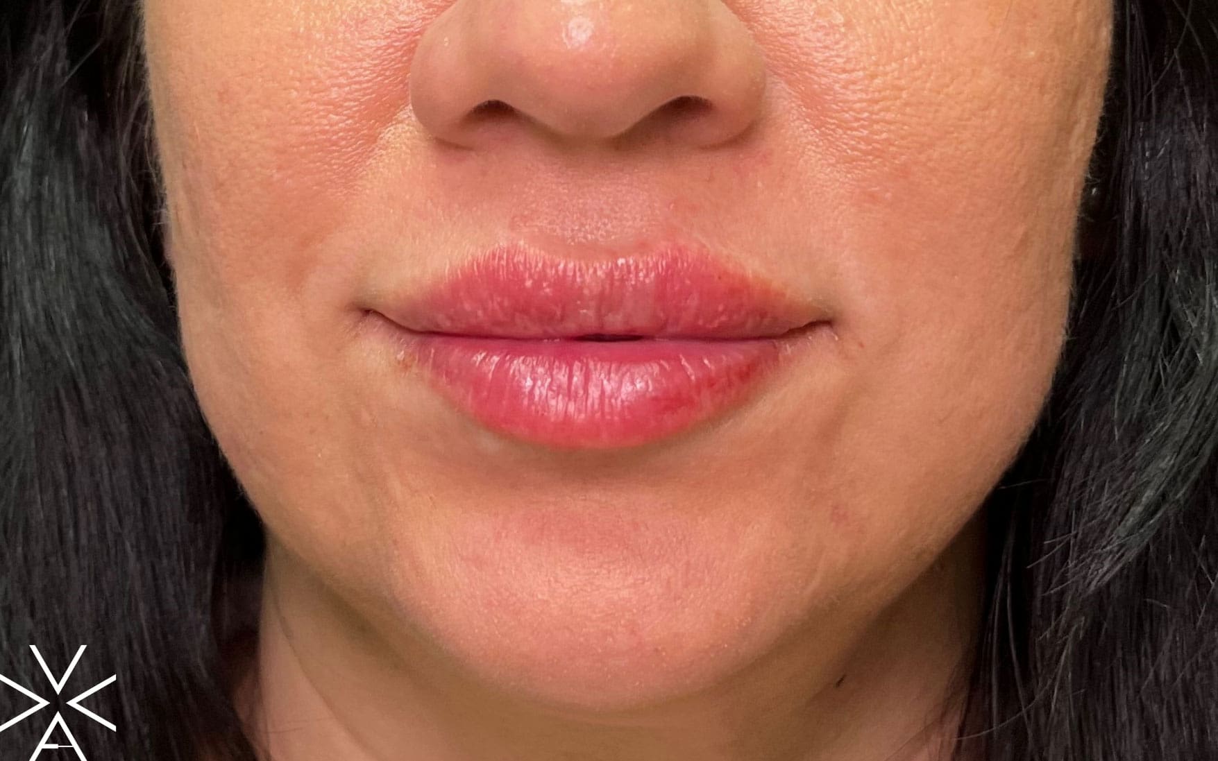 Lip filler after