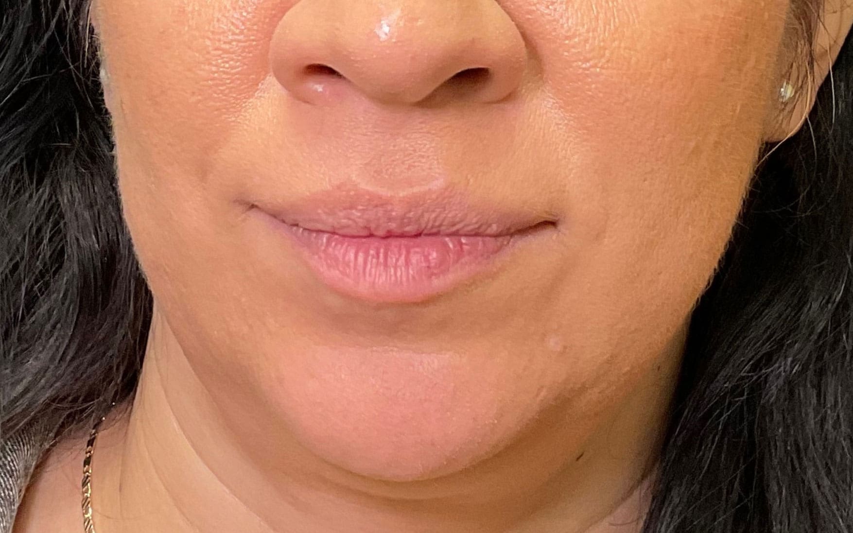 Lip filler before