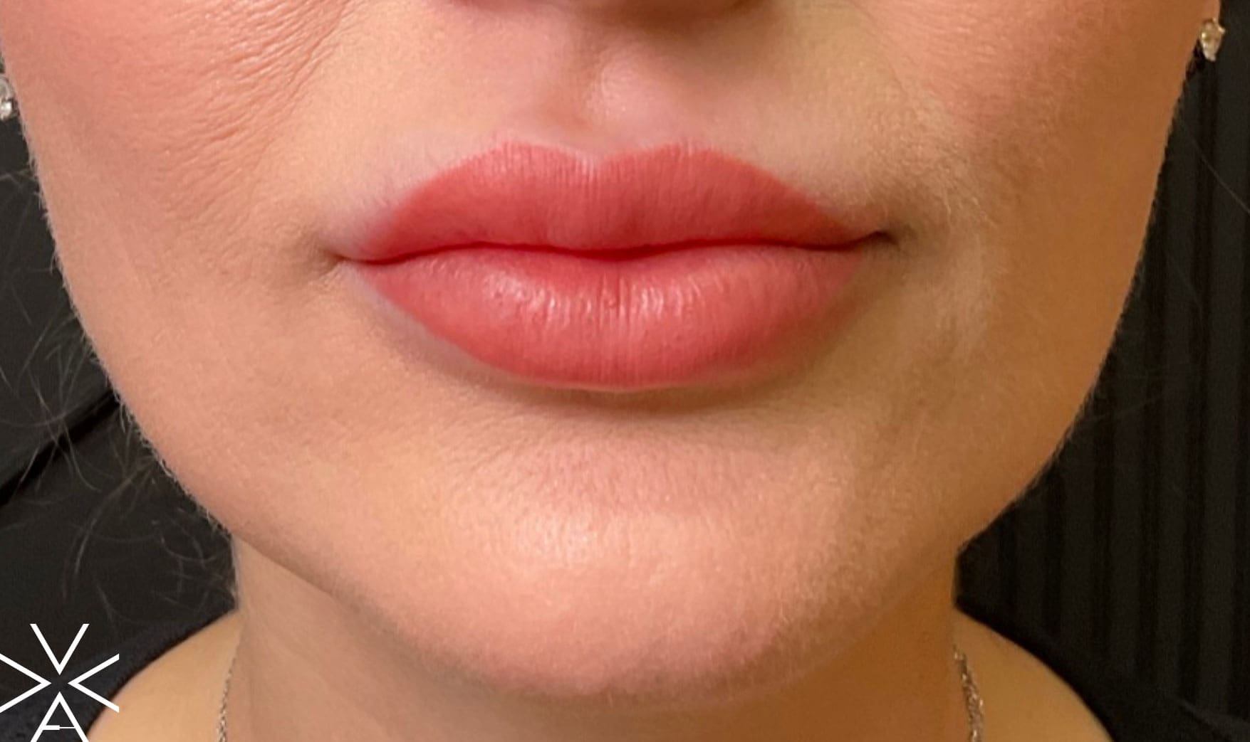 Lip filler after - Before & After Gallery