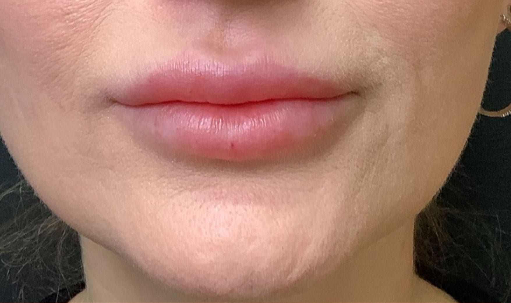 Lip filler before