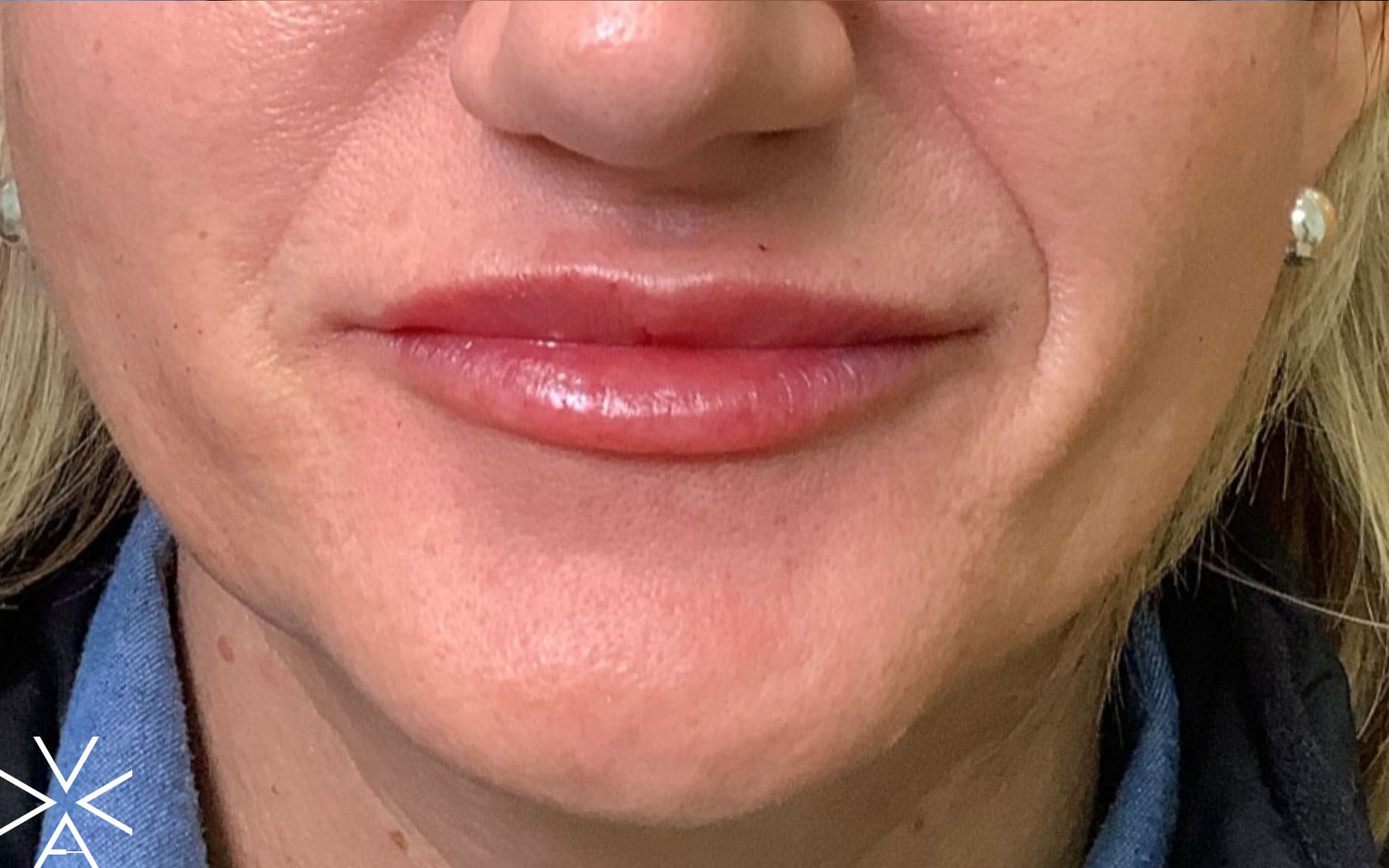 Lip filler after - Before & After Gallery