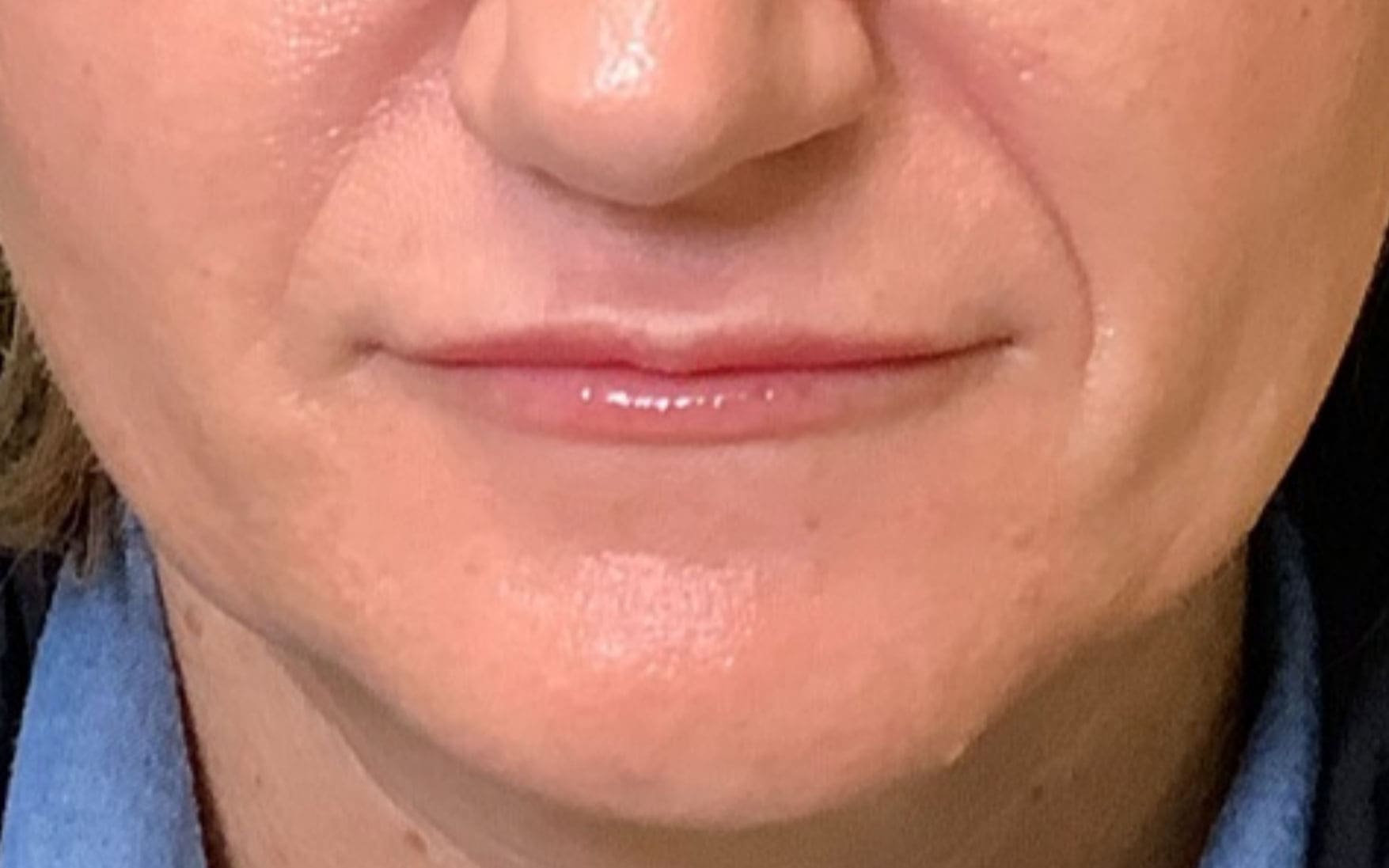 Lip filler before