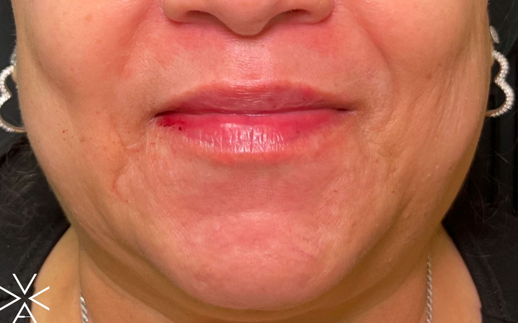 Lip filler after