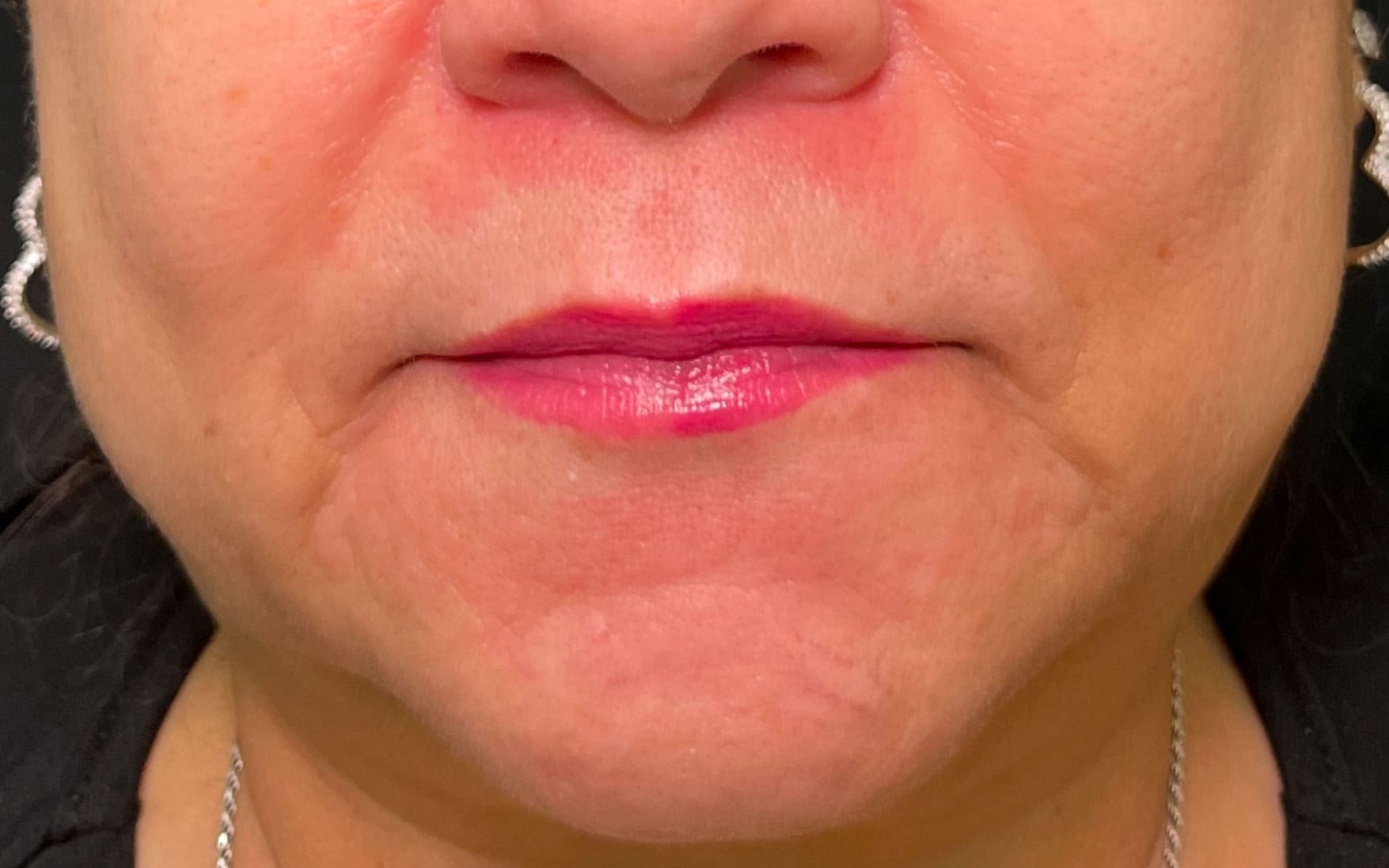 Lip filler before