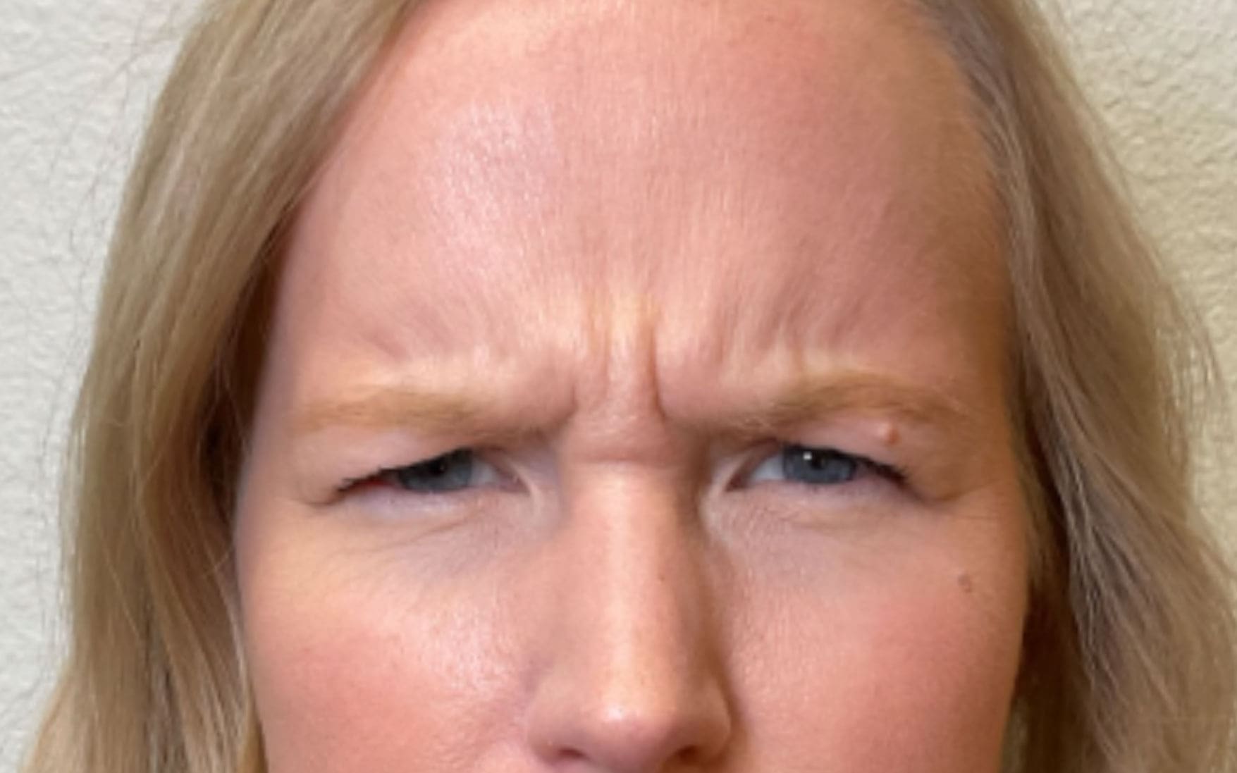 neurotoxin before