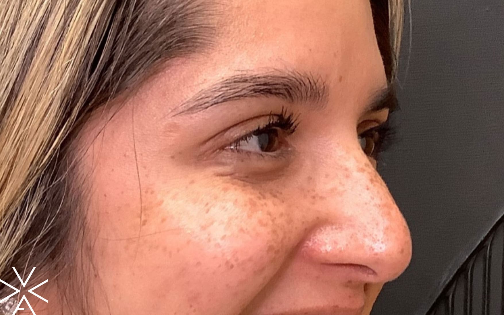 neurotoxin after - Before & After Gallery
