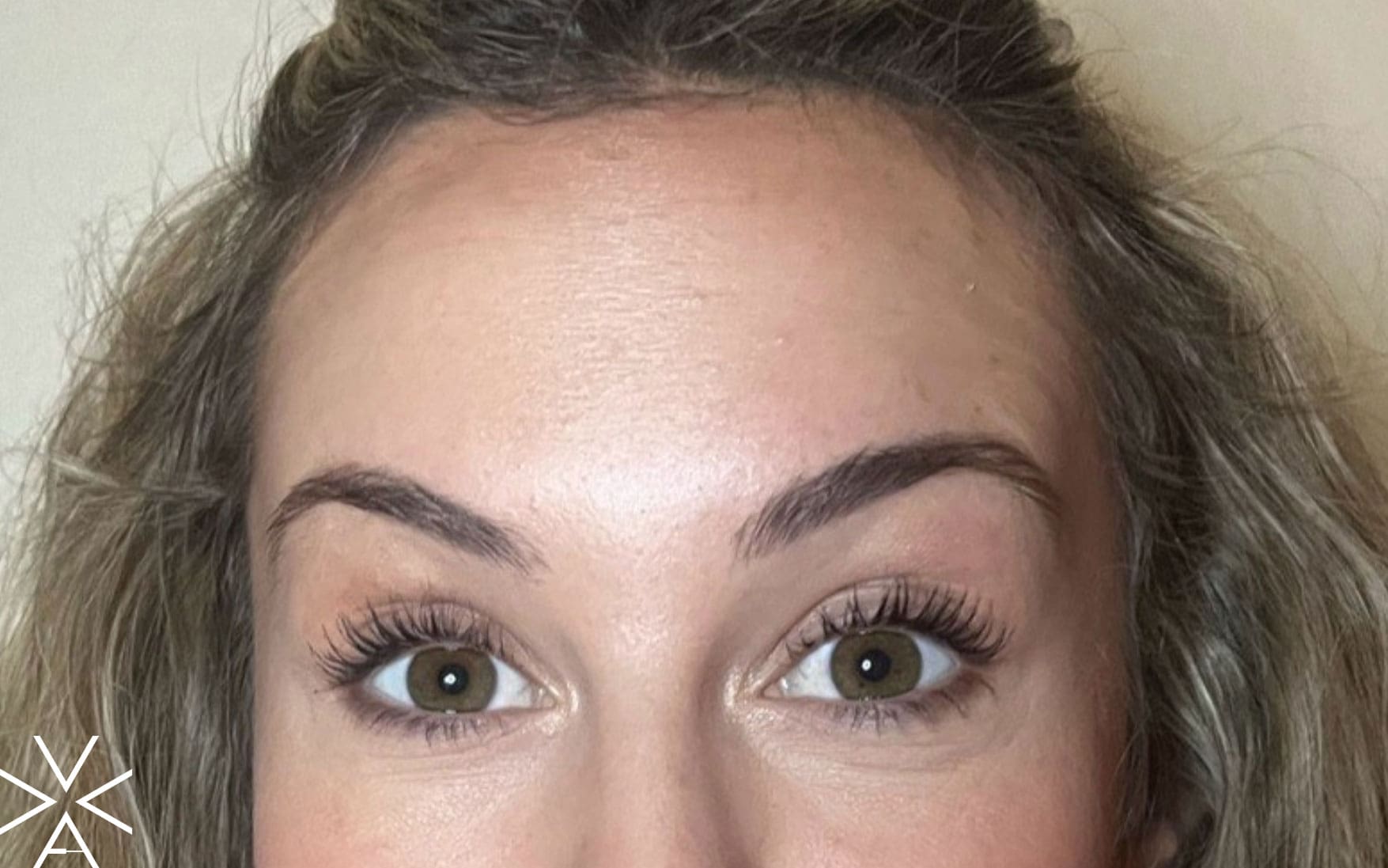 neurotoxin after - Before & After Gallery