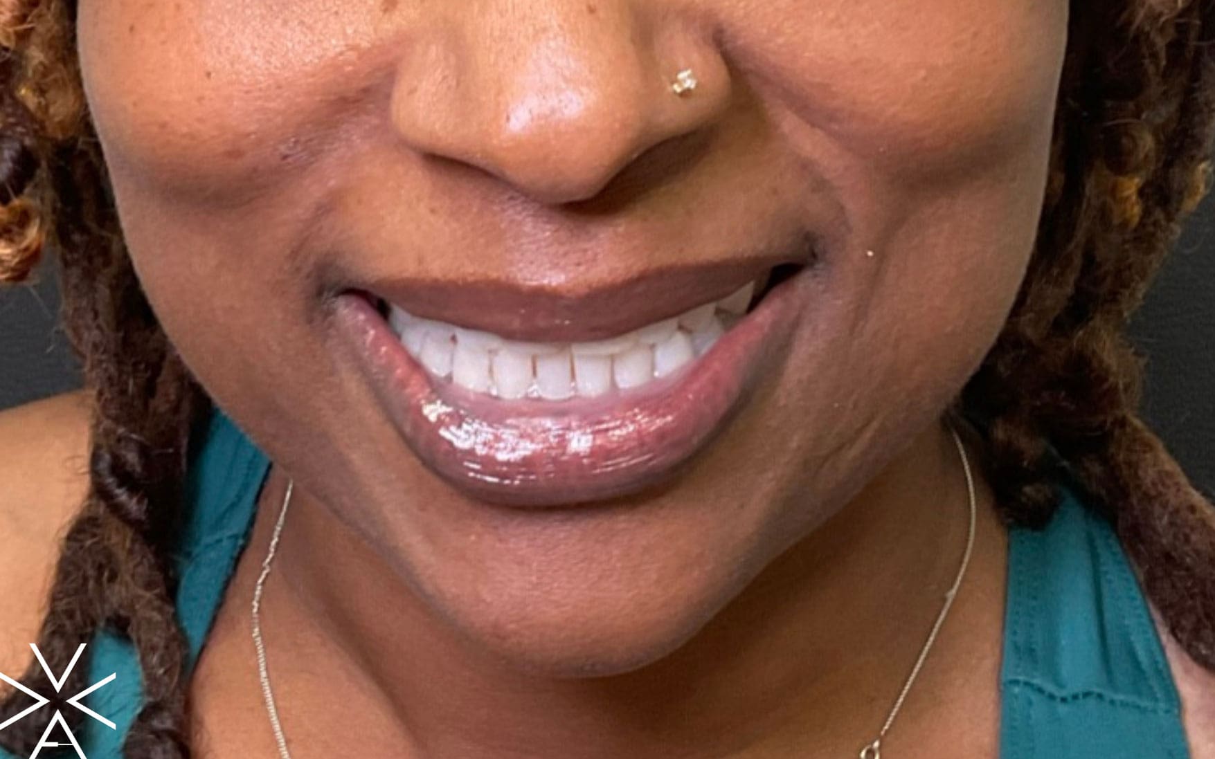 neurotoxin lip flip after - Before & After Gallery