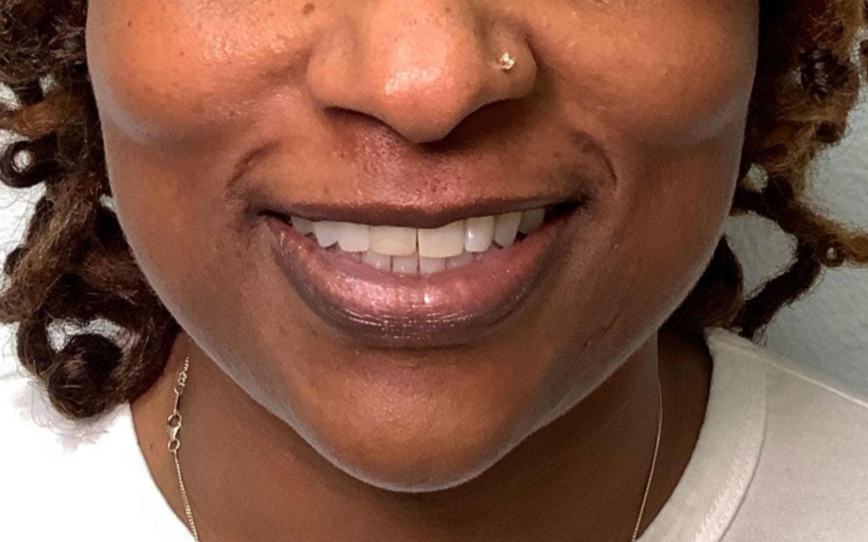 neurotoxin lip flip before