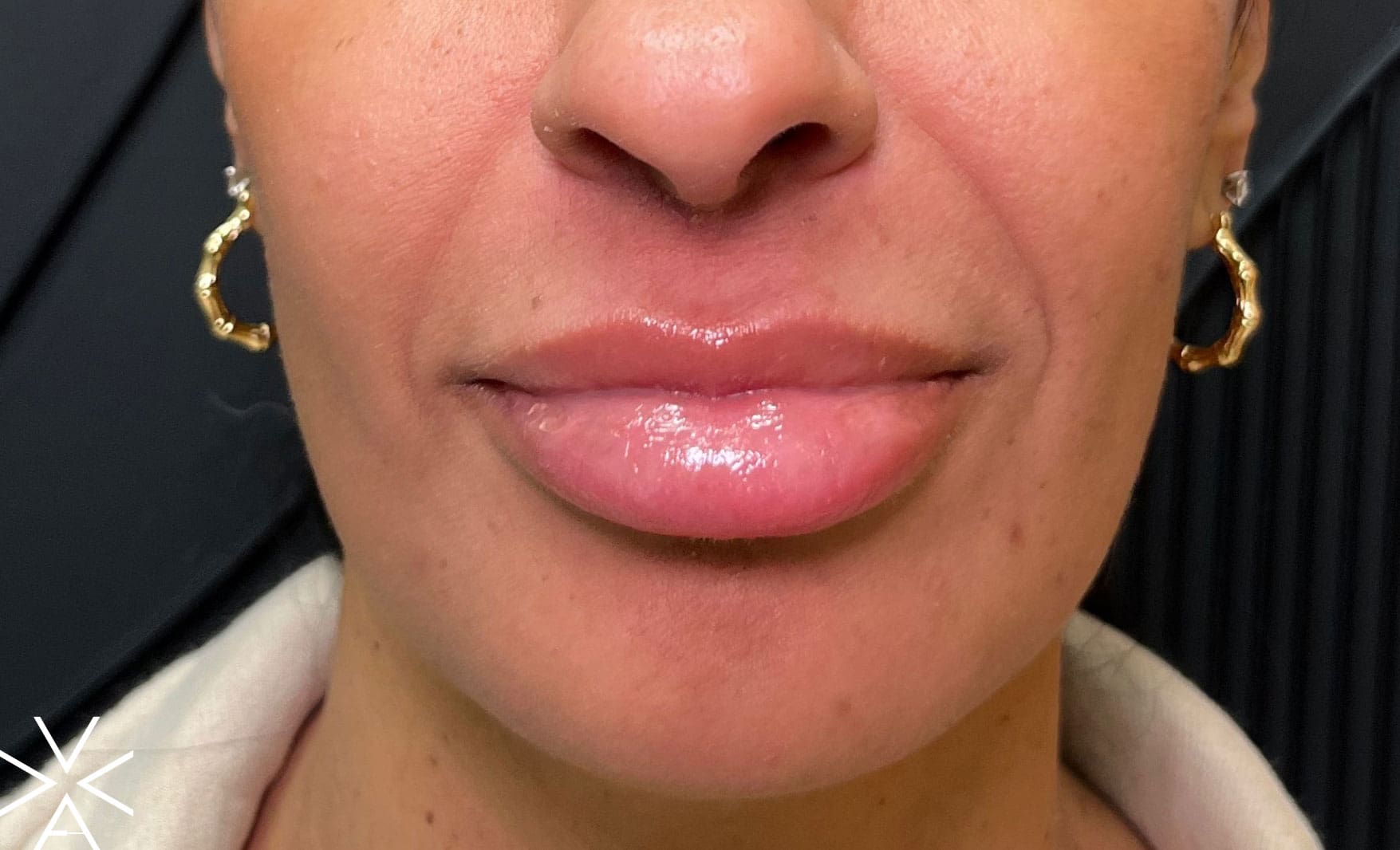 lower face neurotoxin after