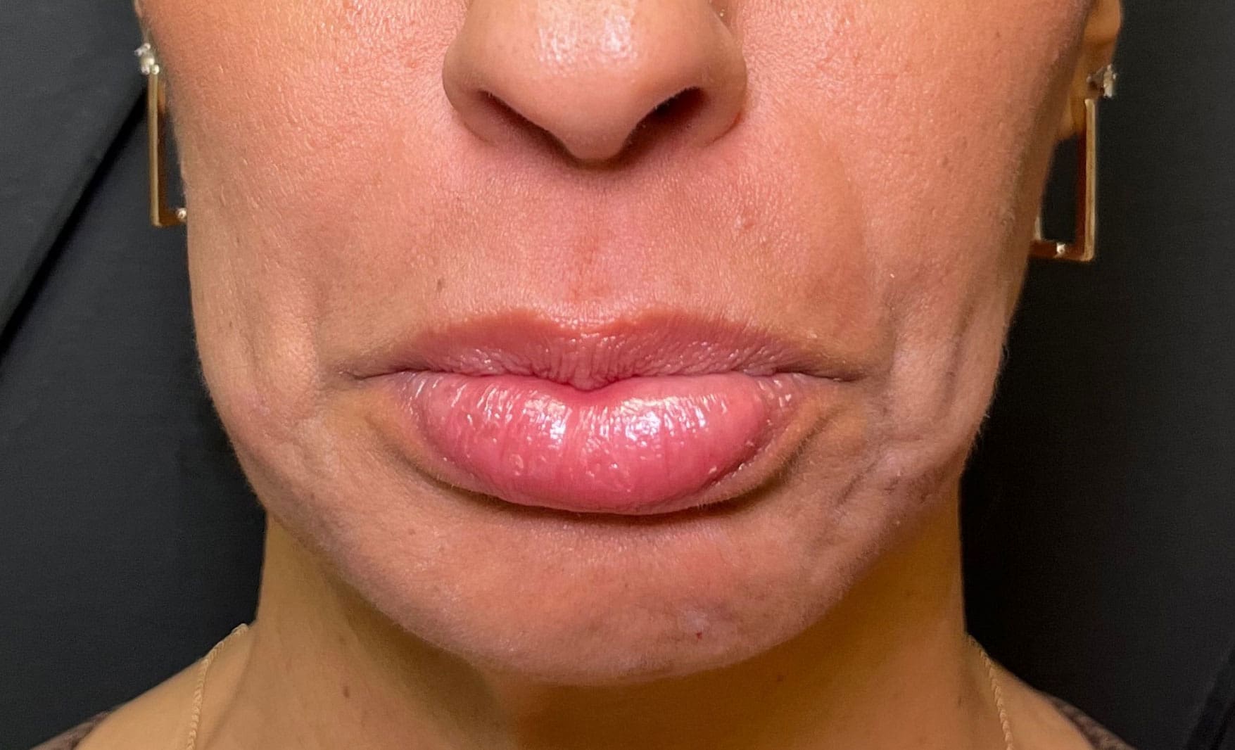 lower face neurotoxin before
